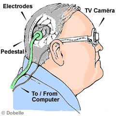 Picture 2 : Eye Prosthesis