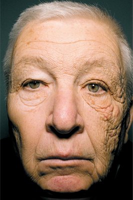 Unilateral-Dermatoheliosis.jpg